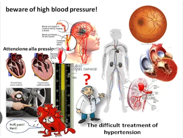 Hypertension artérielle